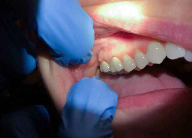 Best Emergency Gum Treatment in Newark, CA